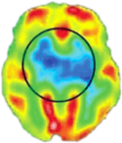 PET CT Scan of the Brain before Stem Cell Therapy