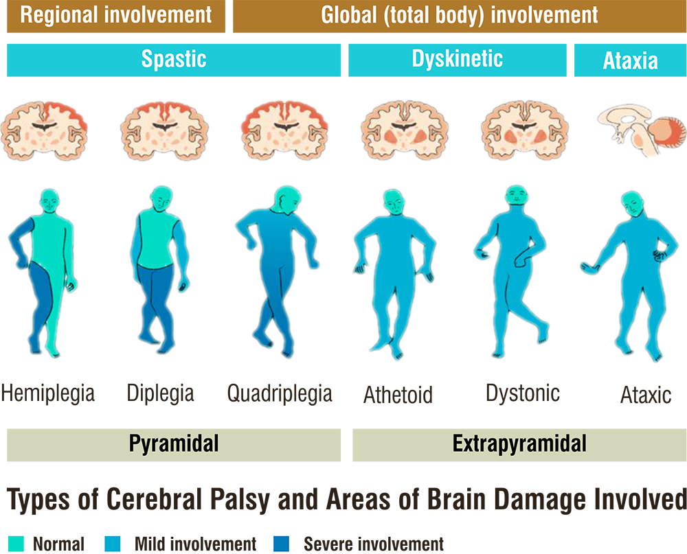 Cerebral Palsy Affects Why Does Cerebral Palsy Affect Speech HEQXD