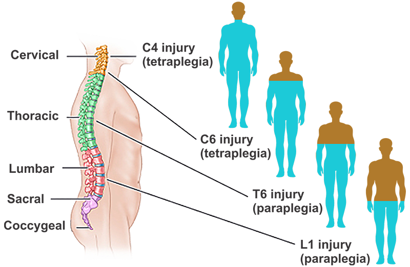 Spinal Cord Injury Cell Therapy